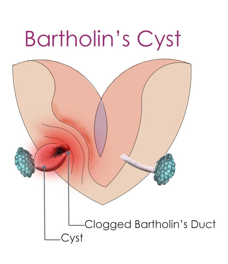What is a Bartholin's cyst and how is it treated?