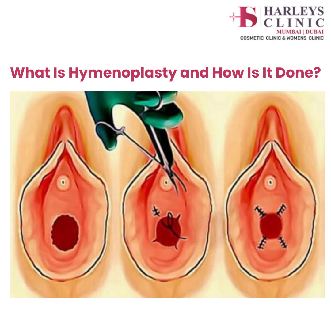 Hymenoplasty