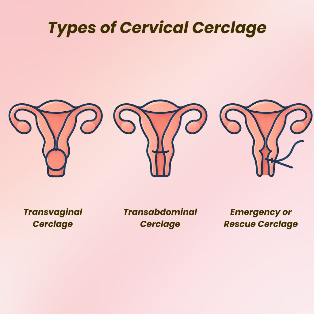What Is Cervical Cerclage Types Procedure Aftercare