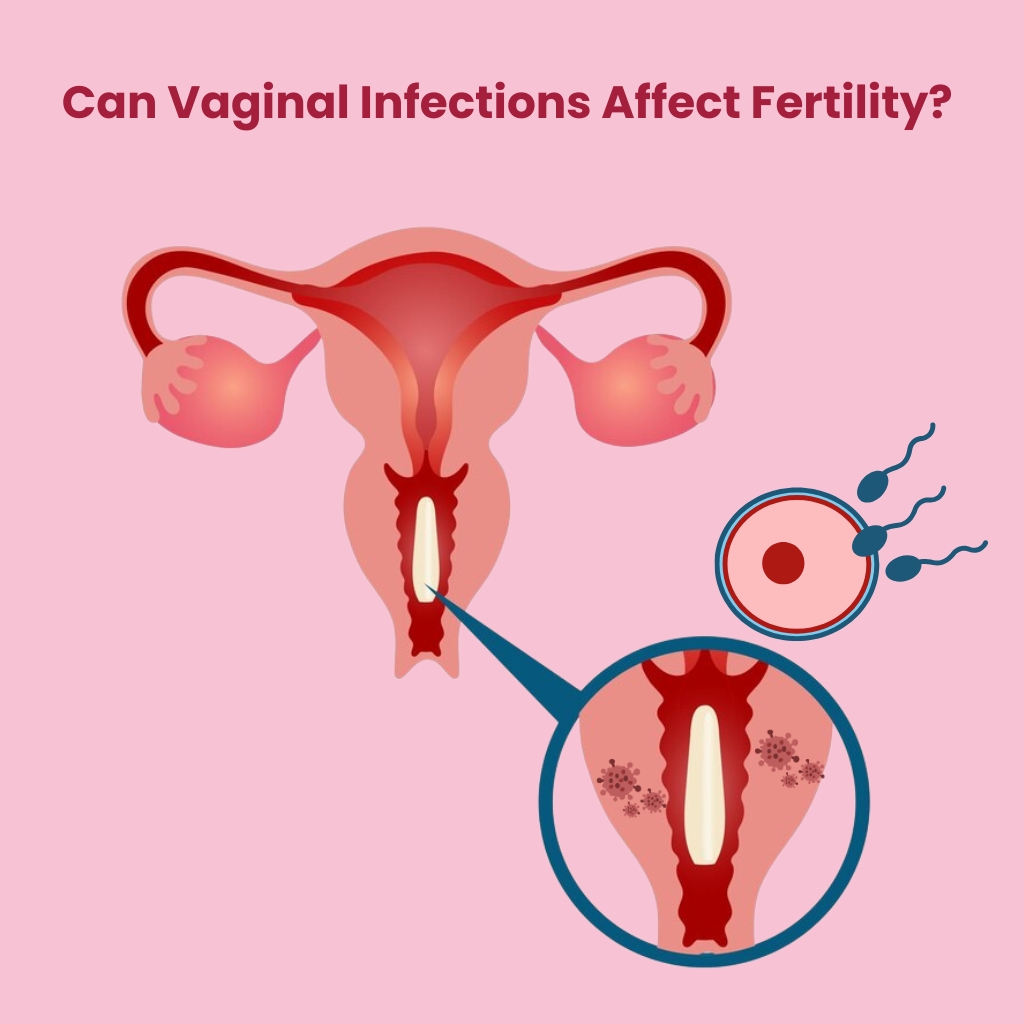 Can Vaginal Infections Affect Fertility