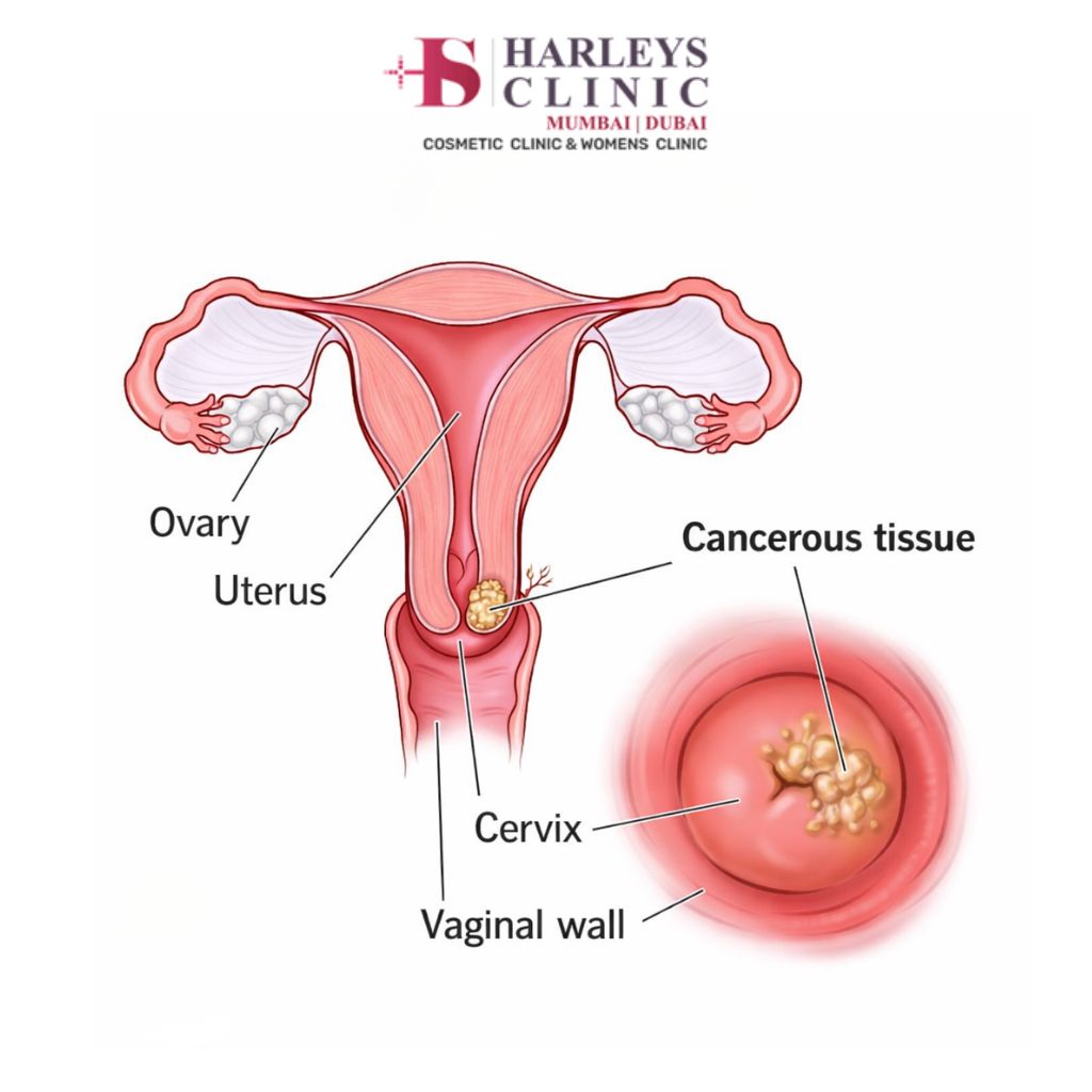 Cervical Cancer treatment in andheri