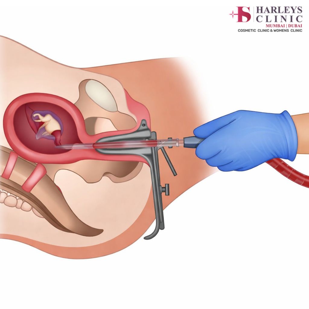 Early Abortion - Dr. Shilpa